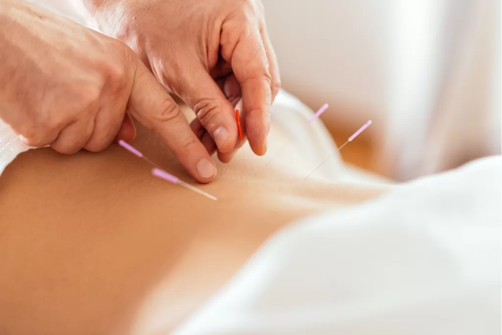 Acupuncture Treatment